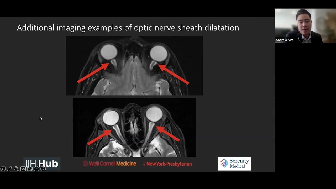 IIH Imaging - Video 2