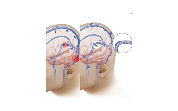 Idiopathic Intracranial Hypertension & Stents