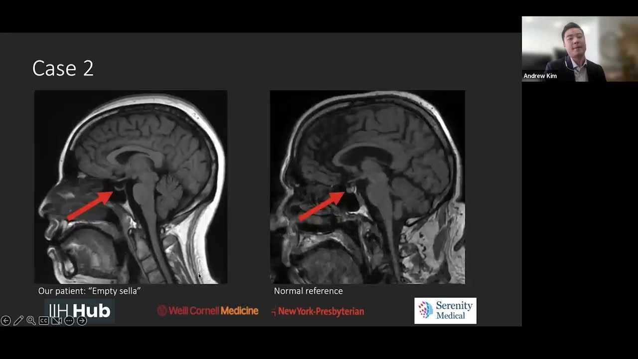 IIH Imaging - Video 3